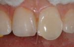 Figure 16 A final layer of clear translucent incisal composite was applied.