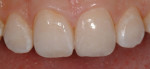 Figure 20 The completed anterior restoration
demonstrated seamless esthetics with the adjacent natural tooth structure.