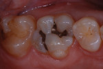 Figure 1 Preoperative view of defective
restorations in teeth Nos. 2 and 3.