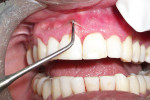 Figure 2  Gingival epithelium being peeled off with a straight probe in maxillary anterior region.