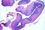 Figure 3  Histologic features showing hyperplastic parakeratinized stratified squamous epithelium with acanthosis, hydropic degeneration of the basal layer, and saw tooth rete-pegs (H&E stain, 20x magnification).