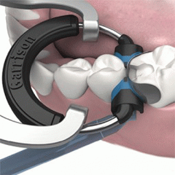 Composi-Tight 3D XR™ by Garrison Dental Solutions