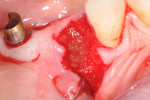 Figure 4  CPS putty placed into No. 29 extraction socket; note absence of the buccal plate.