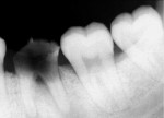 Figure 13  Radiograph of No. 19; note fractured crown showing no periapical pathology.