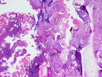 Figure 17  Decalcified specimen demonstrating good bone fill along with richly vascular marrow tissue. Also noticeable are the osteocytes embedded in mature bone and some remnants of the graft substitute.