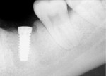 Figure 18  Radiograph of implant placed into grafted site 3 months post fixture placement.