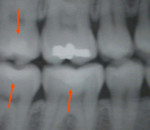This image illustrates the increasing difficulty in making dental identifications. Composites do not have the same radiopacity as amalgams and to the untrained eye, can be easily missed during a forensic examination. Three composite restorations are indicated here. Can you find the fourth?