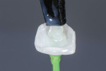 Figure 3 The eCEMENT Translucent shade was selected, as a more opacious lithium disilicate core with layered porcelain over the facial was used to cover the underlying tooth color.