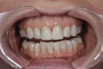 Figure 1 Pretreatment. The patient disliked the color and shape of her veneers and desired a whiter, more esthetic smile.