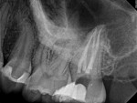 Figure 2 through Figure 5 Examples of root canals enlarged and shaped using a wide variety of instruments (Figure 2 and Figure 3 courtesy of of Dr. William Nudera and Dr. Joy Field).