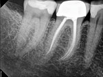 Figure 2 through Figure 5 Examples of root canals enlarged and shaped using a wide variety of instruments (Figure 2 and Figure 3 courtesy of of Dr. William Nudera and Dr. Joy Field).