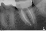Figure 6 and Figure 7 Examples of root canals enlarged and shaped based on canal anatomy, using at least three different NiTi rotary systems during canal preparation (Courtesy of Dr. Torsten Stenig and Dr. Joy Field).