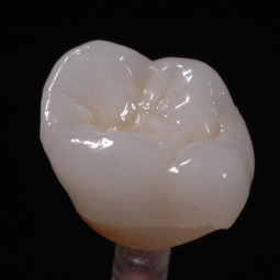e.max® Restorations by BonaDent™ Dental Laboratories