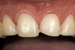 Figure 3  Enamel replacement veneer preparations: 0.3 mm of reduction cervically and 0.5 mm of reduction on the mid facial.