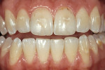 Figure 5  A patient who presents with pleasing tooth shape but unattractive facial enamel as well as caries to dentin where orthodontic brackets had been.