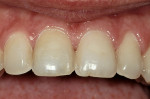 Figure 7  Final enamel replacement preparations following direct bonding where the caries had been. Note the incisal edge has not been reduced in length, only on the facial.