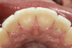 Figure 9  Incisal view showing the lingual half of the incisal edge is still enamel and the facial is half ceramic.