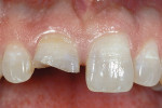 Figure 14  A central incisor fractured in an auto accident without any pulpal involvement.
