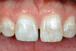 Figure 16  The final restoration is a homogenous (pressed ceramic) crown bonded to provide acceptable resistance and retention.