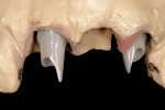 Figure 17  A zirconia milled abutment on implants.