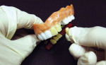 Figure 8. Denture teeth can be positioned using wax, self-curing acrylic, or by any other 7 procedure-appropriate method.
