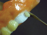 Figure 10 and Figure 11. Composite veneer placement is shown over denture teeth Nos. 12 and 13. Composite material retention is enhanced by prepared roughened FDM surfaces of the
preparation, but can be removed largely intact and replaced if surfaces are lubricated.