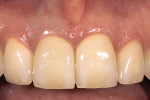 Figure 5  Final nonhomogenous restorations using a thicker, more opaque alumina core to mask the dark preparation. This is an ideal situation for zirconium oxide-based restorations as well.