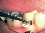 Figure 4   Removing excess provisional cement with a scaler