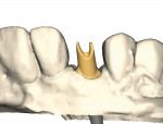 Figure 1. An implant abutment is digitally designed in multiple steps.