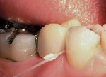 Figure 5  Removing excess provisional cement from the interproximal gingival embrasure with a piece of dental floss that has been knotted several times on the end.