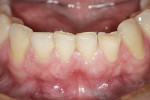 Figure 3  The lower anterior teeth have experienced terminal wear. Canine and protrusive guidance have been completely lost.