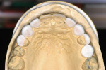 Figure 8  Functional lingual surfaces were restored to the maxillary anterior teeth in the diagnostic phase.