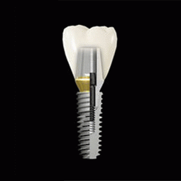 ET III SA Implant by Hiossen