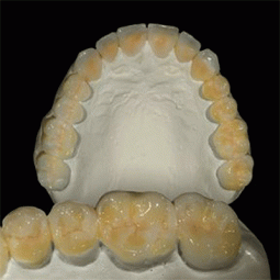 Treatment Plan Wax-Up by LSK121 Oral Prosthetics