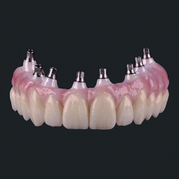 Prettau Zirconia Implant Bridge by Tischler Dental Laboratory