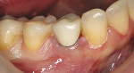 Figure 1  Clinical view of existing porcelainfused to-metal crown depicting metal margin and increasing value.