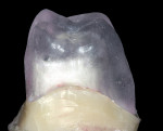 Figure 13  Plastic full-contour portion of the restoration placed on the duplicate die. The zirconia coping is seated underneath.