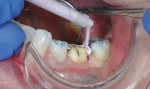 Figure 3 digit power™ Dispenser and Aquasil Ultra Cordless Tissue Managing Impression single-unit wash material being used to capture a final impression for tooth No. 19. Buccal retracted view.