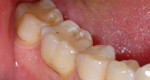 Figure 7 Case 2: Preoperative view of 40-year-old patient, treatment planned for lithium-disilicate crowns on teeth Nos. 30 and 31. Buccal retracted view.