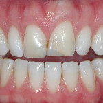 Figure 4 Case 1: Preoperative retracted view of 25-year-old patient complaining of the appearance of his maxillary central incisors.