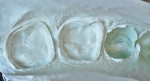 Figure 8 Final impression of teeth Nos. 30 and 31 taken with Aquasil Ultra Cordless material.