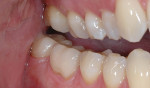 Figure 10 Completed lithium-disilicate crowns, teeth Nos. 30 and 31. Retracted buccal view.