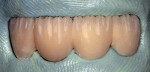 Figure 22  The restoration was positioned in the silicone index after cutting back the incisal areas.