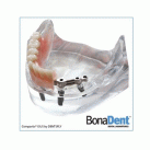 Implant-Supported Overdentures by BonaDent™ Dental Laboratories