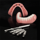 Inclusive® Mini Implant Overdenture by Glidewell Laboratories