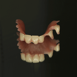 Partial Dentures by LSK121 Oral Prosthetics