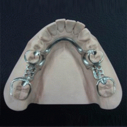 Partial Frameworks by Sunset Dental Lab