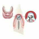 Atlas Denture Comfort® by Dentatus USA Ltd
