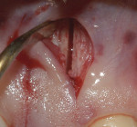 Figure 4 Corticotomies 2-mm to 3-mm-deep were performed through the incisions of the mucosa.