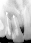 Figure 3 Radiograph of teeth Nos. 7 and 8 showing periapical pathosis.